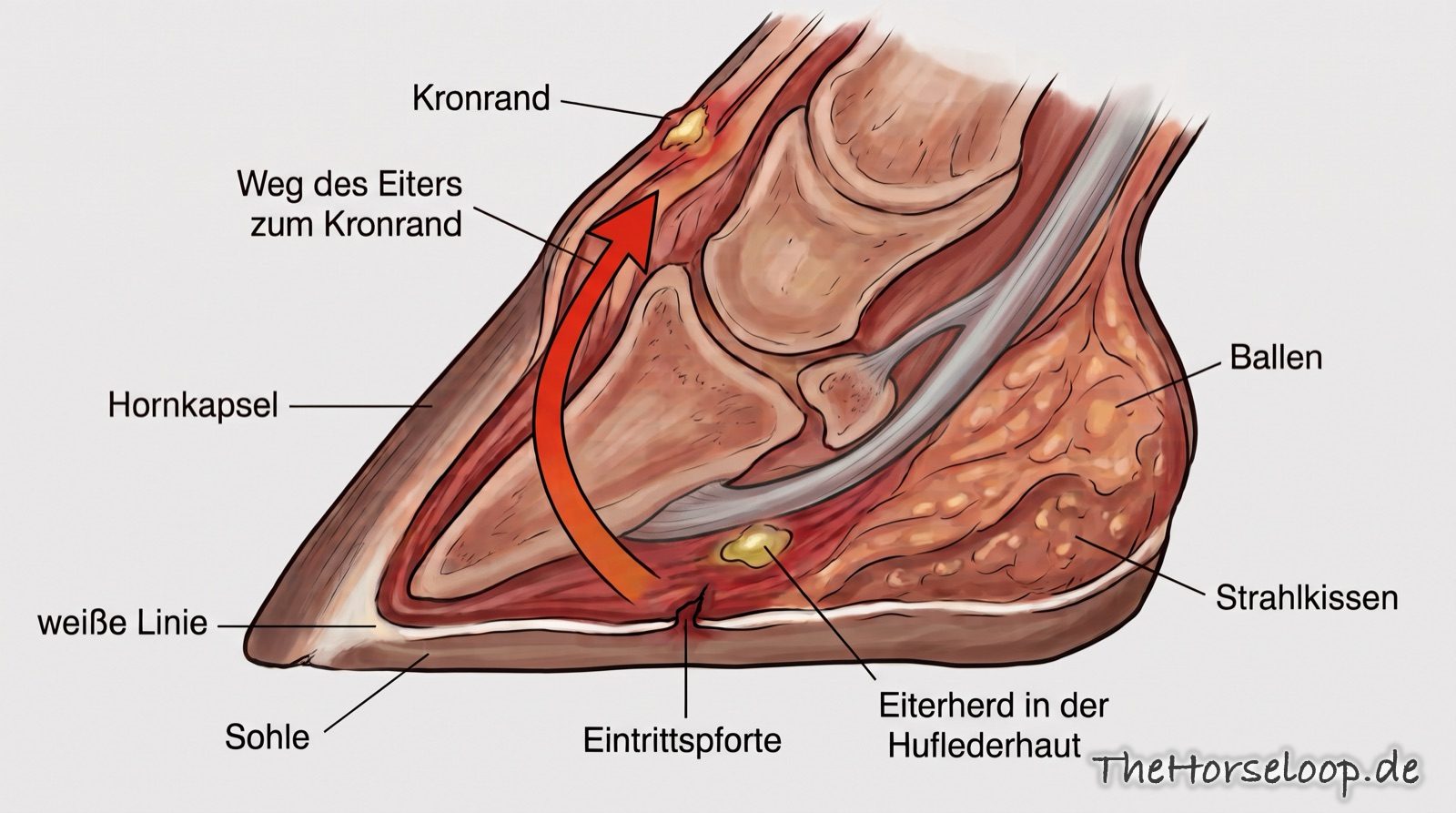 Schematischer Längsschnitt durch einen Pferdehuf mit Eintrittspforte an der Hufunterseite, Eiterherd in der Huflederhaut und einem Pfeil, der den Weg des Eiters zwischen Hornkapsel und Hufbein nach oben zum Kronrand zeigt.