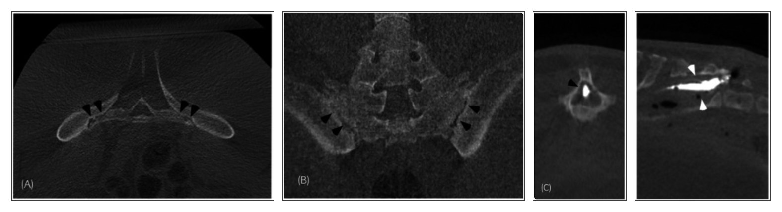 CT-Aufnahmen der Iliosakralregion beim Pferd im Knochenfenster: Transversal- und Frontalschnitt auf Höhe des Iliosakralgelenks mit unregelmäßiger Gelenkkontur sowie Transversal- und Sagittalschnitt eines weiteren Pferdes mit dorsalem Hautsinus und Kontrastmittel im Fistelgang