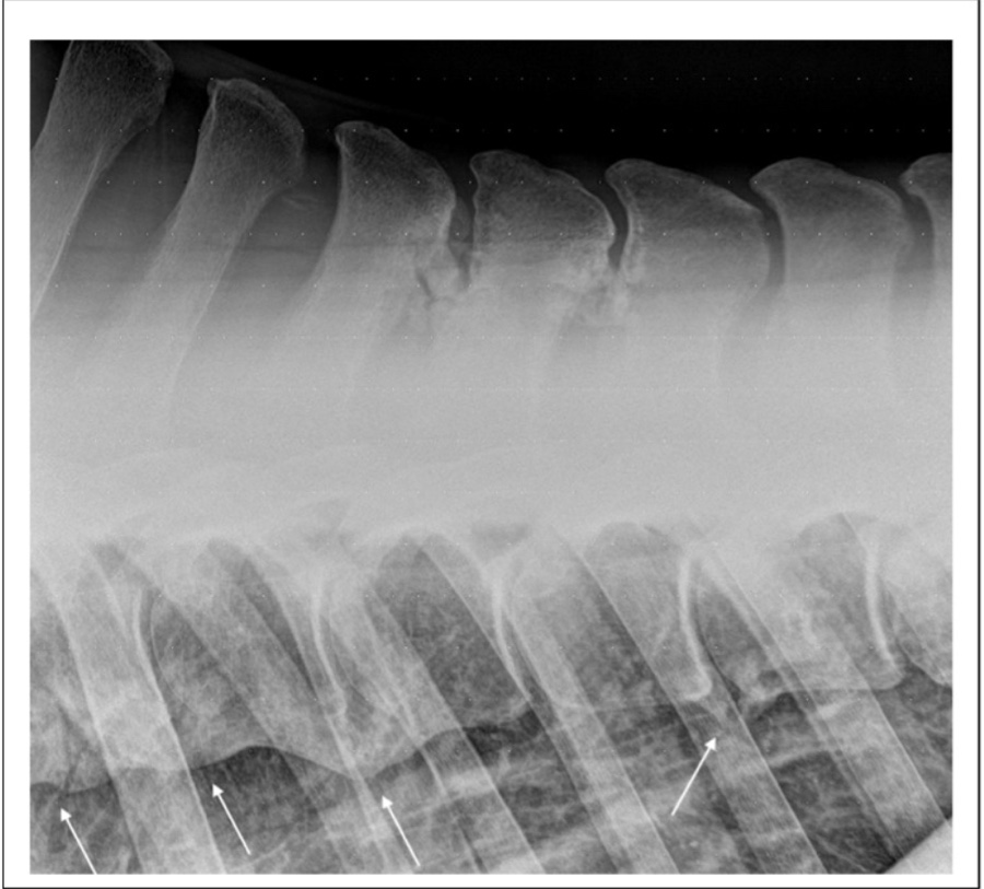 Seitliche Röntgenaufnahme der mittleren Brustwirbelsäule eines 20-jährigen Dressurponys mit ausgedehnten Verknöcherungen im Zwischendornfortsatzraum Th11 bis Th13 und fortgeschrittener Spondylose der Wirbelkörper (Pfeile)